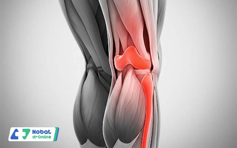 علت درد پشت زانو | نوبت دکتر آنلاین