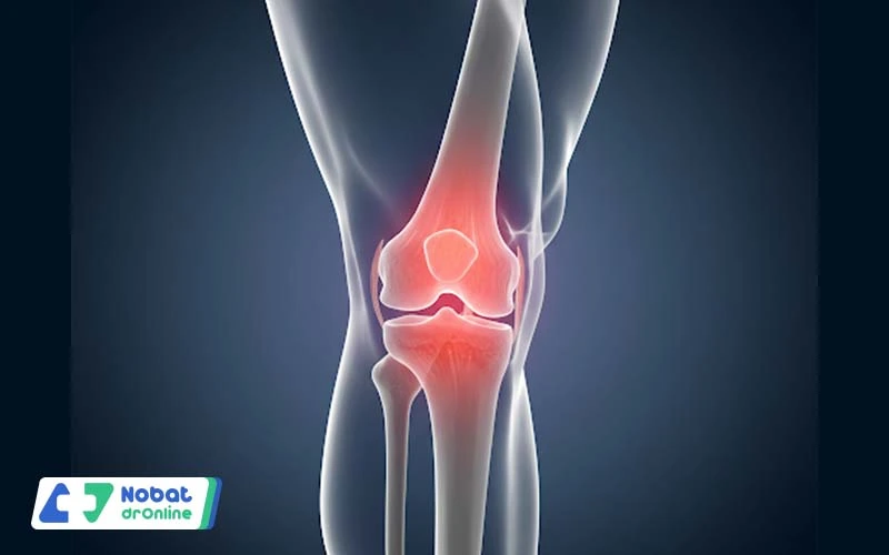 سندروم پای دوندگان | نوبت دکتر آنلاین