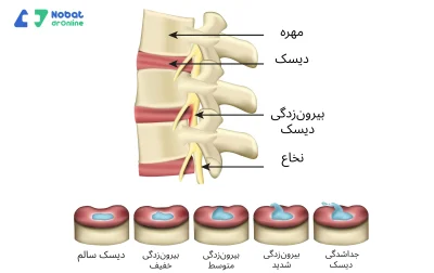 عکس بیرون زدگی دیسک کمر